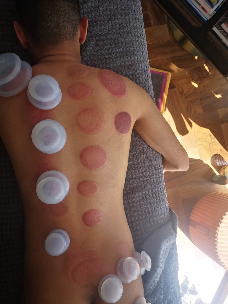 Cupping therapy for fascial release at Mayfair clinic